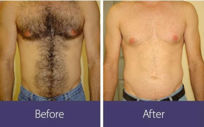 How Long Does Laser Hair Removal Last Boston Laser Hair Removal Krauss Dermatology