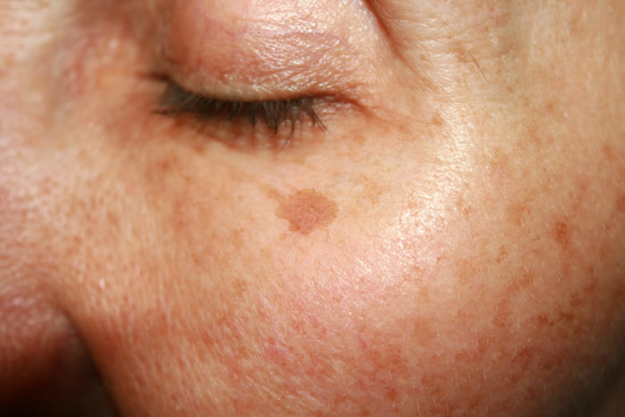 Common Skin Spot Treatments Boston & Wellesley