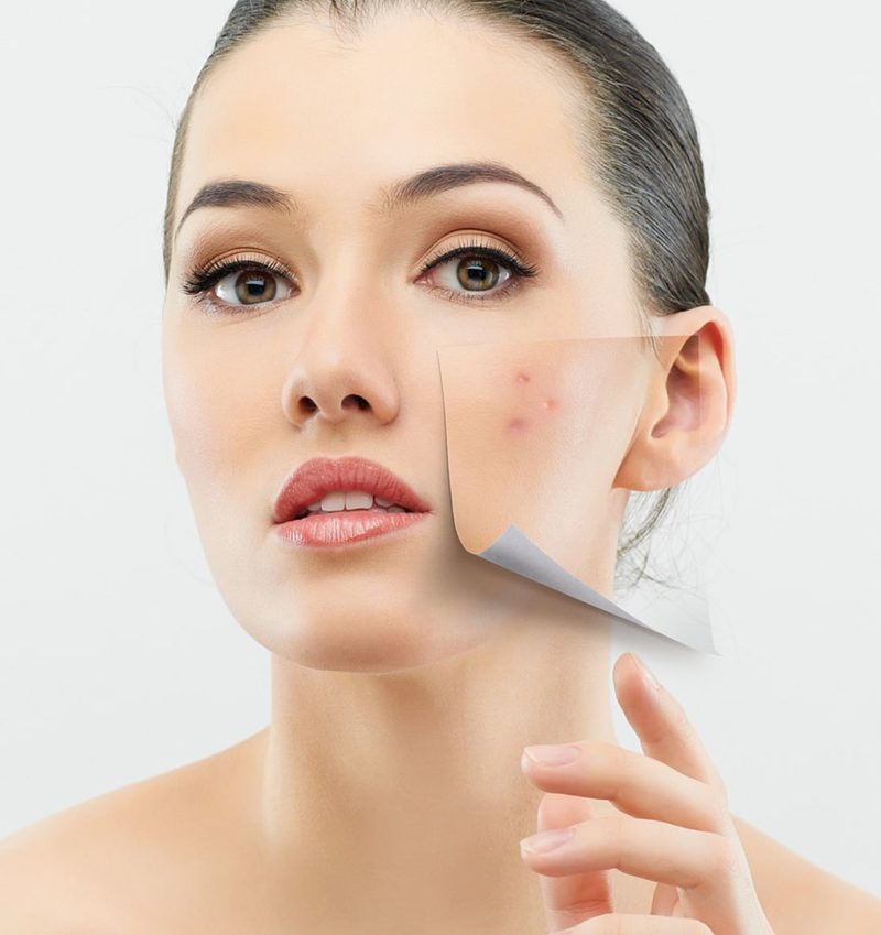 Best Acne Treatment Boston & Wellesley, MA Krauss Dermatology