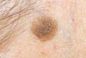 Common Skin Spot Treatments Boston Wellesley Krauss Dermatology