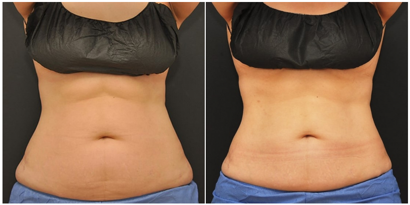 How Effective is CoolSculpting®?